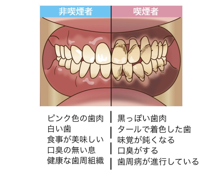 ～タバコとお口の健康～