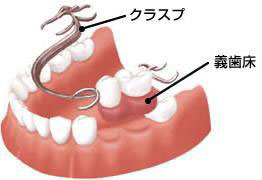 プラスチック義歯（保険適用）