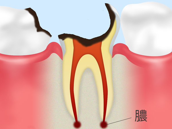 神経が死んだ虫歯