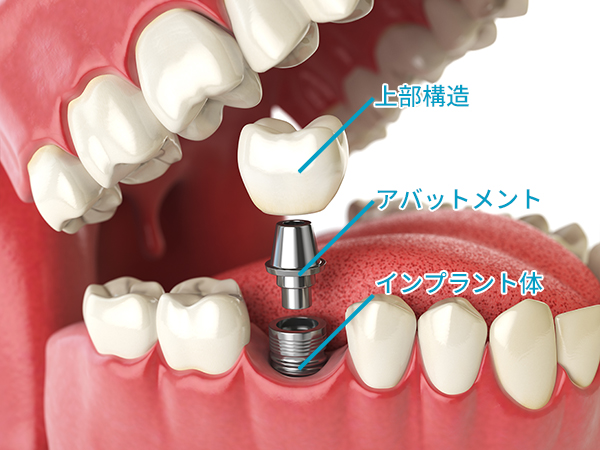 3つのパーツからなるインプラント