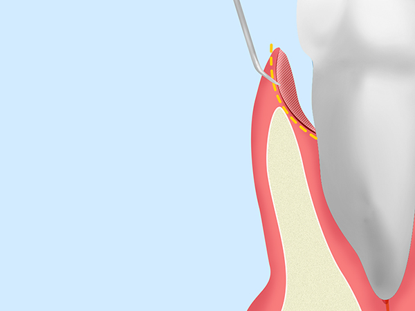 歯周ポケット掻把術